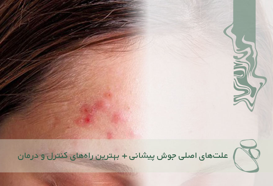 علت‌های اصلی جوش پیشانی + بهترین راه‌های کنترل و درمان